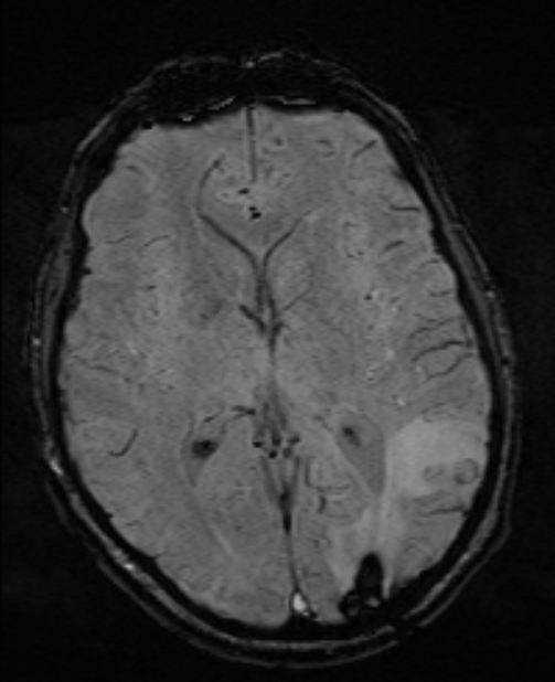 Brain metastases - lung cancer primary (Radiopaedia 75060-86115 Axial SWI 33).jpg