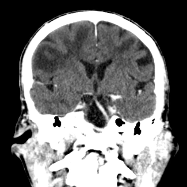 Brain metastases from lung cancer (Radiopaedia 27849-28092 Coronal C+ delayed 31).jpg