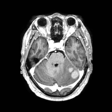 Brain metastases from lung cancer (Radiopaedia 83839-99028 Axial T1 C+ 17).jpg