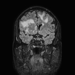 File:Brain metastases from lung cancer (Radiopaedia 83839-99028 Coronal FLAIR 30).jpg
