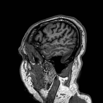Brain metastases from lung cancer (Radiopaedia 83839-99028 Sagittal T1 114).jpg