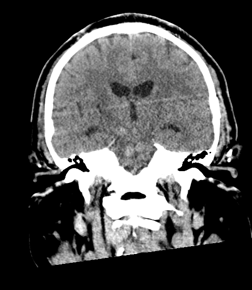 Brainstem hemorrhage (Radiopaedia 81294-94976 Coronal non-contrast 37).jpg