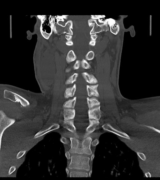 Branchial cleft cyst (Radiopaedia 31167-31875 Coronal bone window 44).jpg