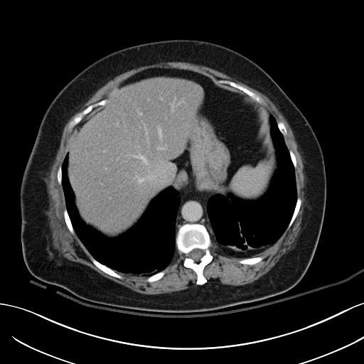 Breast carcinoma with pathological hip fracture (Radiopaedia 60314-67974 B 11).jpg