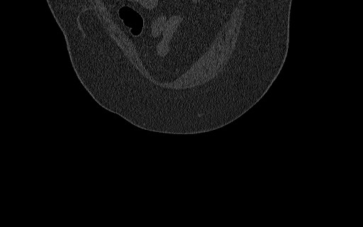 File:Breast carcinoma with pathological hip fracture (Radiopaedia 60314-67993 Coronal bone window 28).jpg