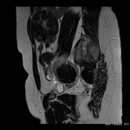 File:Broad ligament fibroid (Radiopaedia 49135-54241 Sagittal T2 21).jpg