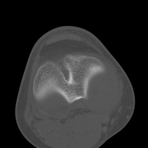 Brodie abscess of the tibia (Radiopaedia 58984-66250 Axial bone window 56).jpg