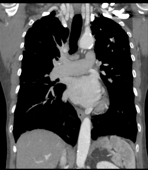 Bronchial artery aneurysms (Radiopaedia 42282-45385 Coronal C+ delayed 35).png