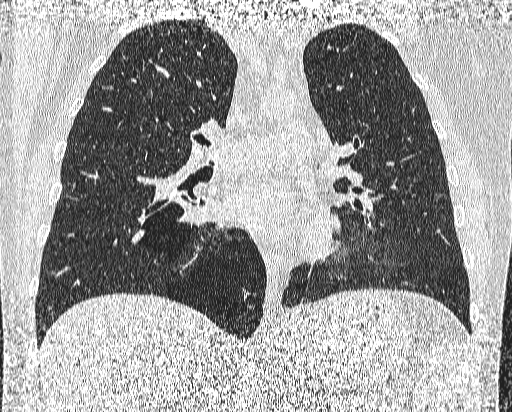 Bronchial atresia (Radiopaedia 58271-65417 Coronal lung window 28).jpg