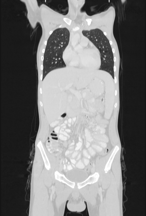 Bronchial carcinoid tumor (Radiopaedia 57187-64090 Coronal lung window 31).jpg