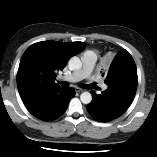 Bronchial carcinoid tumor (Radiopaedia 67377-76764 A 29).jpg