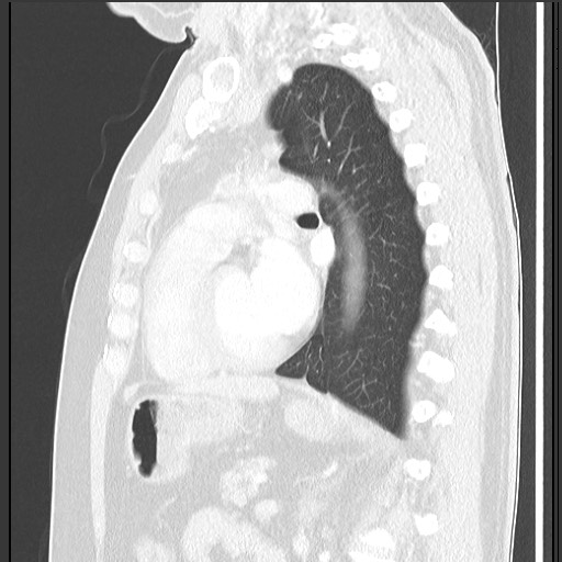 File:Bronchial carcinoid tumor (Radiopaedia 67377-76764 Sagittal lung window 42).jpg