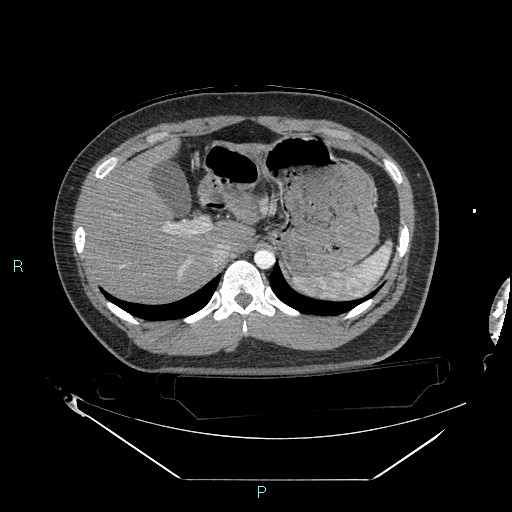 Bronchial carcinoid tumor (Radiopaedia 78272-90870 B 115).jpg