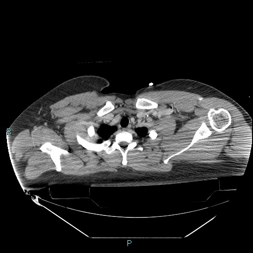 Bronchial carcinoid tumor (Radiopaedia 78272-90870 C 20).jpg