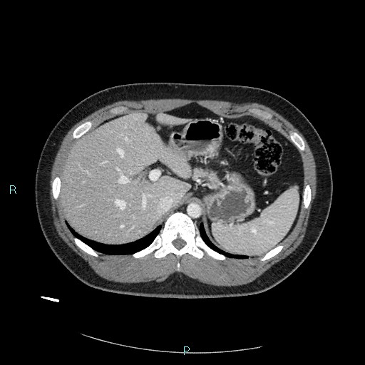Bronchial carcinoid tumor (Radiopaedia 78272-90875 A 93).jpg