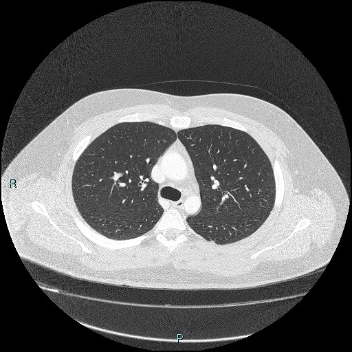 Bronchial carcinoid tumor (Radiopaedia 78272-90875 Axial lung window 16).jpg