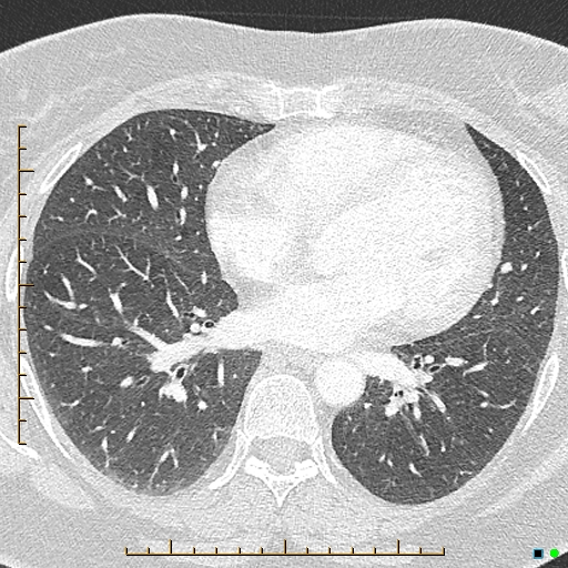 File:Bronchial diverticula (Radiopaedia 79512-92676 Axial lung window 122).jpg