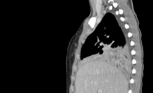 Bronchial mucoepidermoid carcinoma (Radiopaedia 57023-63895 Sagittal 65).jpg