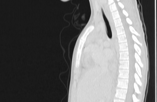 Bronchial mucoepidermoid carcinoma (Radiopaedia 57023-63895 Sagittal lung window 78).jpg