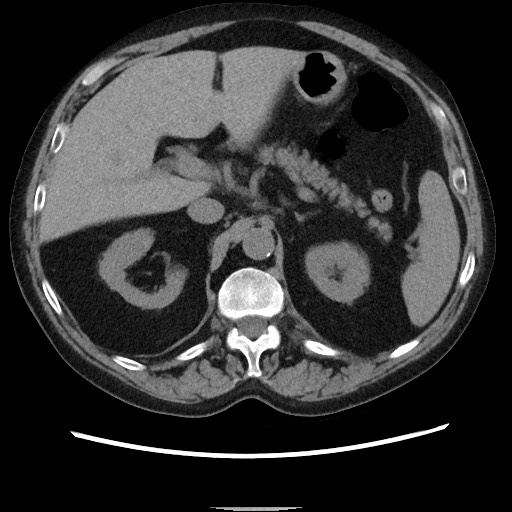 Bronchial stenosis - lung transplant (Radiopaedia 73133-83848 Axial non-contrast 62).jpg