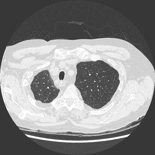 File:Bronchial stenosis - lung transplant (Radiopaedia 73133-83848 C 3).jpg