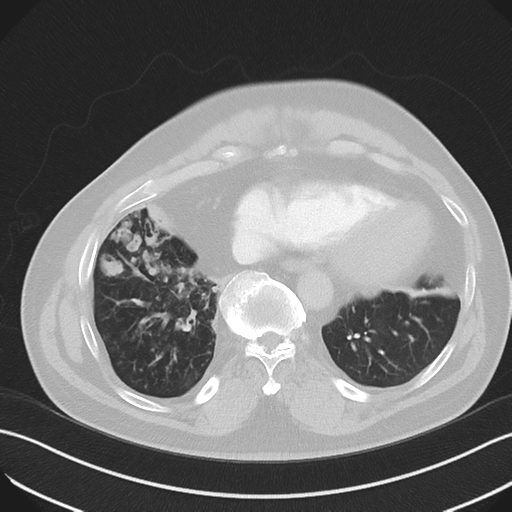 Bronchiectasis (Radiopaedia 39385-41666 Axial lung window 49).png