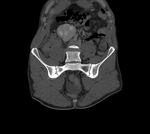 Bronchiectasis in Crohn disease (Radiopaedia 60311-67977 Coronal bone window 14).jpg