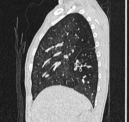 File:Bronchiolitis obliterans (Radiopaedia 71538-81897 Sagittal lung window 17).jpg
