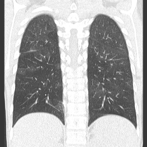 File:Bronchiolotis obliterans (Radiopaedia 73769-84575 Coronal lung window 29).jpg