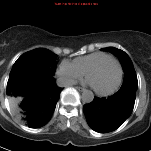 File:Bronchoalveolar carcinoma (BAC) (Radiopaedia 13436-13392 Axial non-contrast 37).jpg
