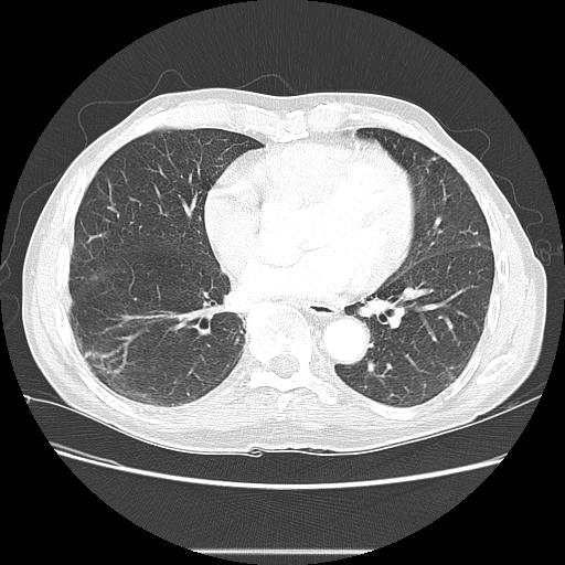 Bronchocele (Radiopaedia 17097-16795 Axial lung window 76).jpg