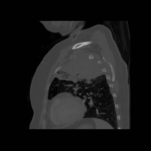 Bronchogenic carcinoma (Radiopaedia 73497-84262 Sagittal bone window 115).jpg