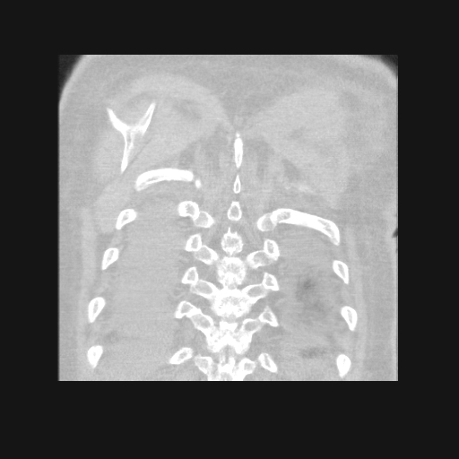 File:Bronchogenic carcinoma with metastatic lymphadenopathy (Radiopaedia 37671-39569 Coronal lung window 43).jpg