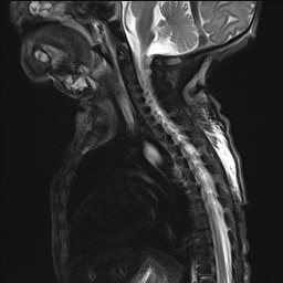 File:Bronchogenic cyst (Radiopaedia 27207-27380 Sagittal STIR 7).jpg