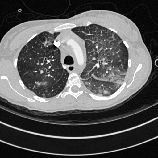 Bronchogenic cyst (Radiopaedia 77801-90071 Axial lung window 15).jpg