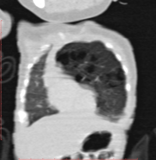 Bronchogenic cyst (Radiopaedia 78599-91409 Coronal lung window 50).jpg