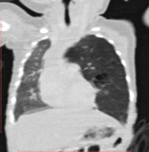 Bronchogenic cyst (Radiopaedia 78599-91409 Coronal lung window 88).jpg