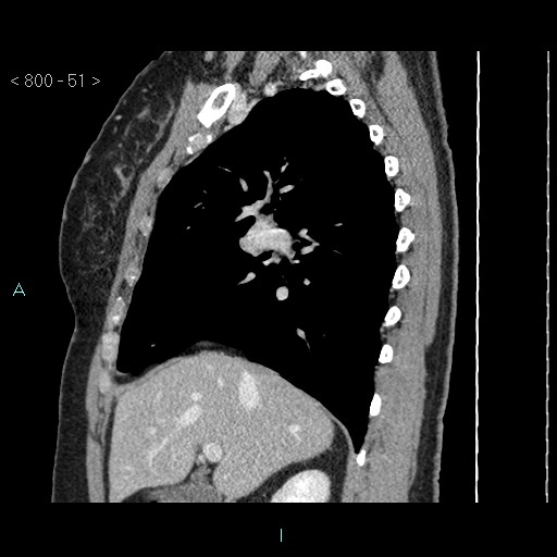 Bronchogenic cyst - posterior mediastinal (Radiopaedia 43885-47364 B 34).jpg