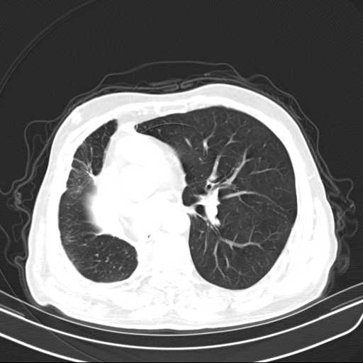 Bronchopleural fistula - postoperative complication (Radiopaedia 21020-20947 Axial lung window 30).jpg
