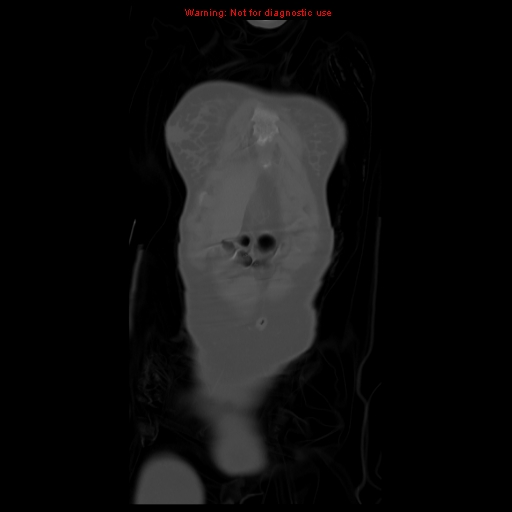 File:Brown tumor (Radiopaedia 12318-12596 D 11).jpg