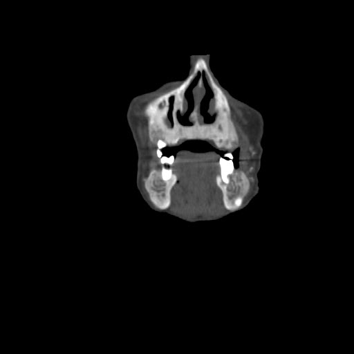 File:Brown tumor with secondary hyperparathyroidism (Radiopaedia 23591-23705 bone window 9).jpg