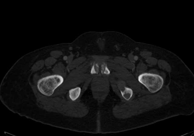 Brown tumors compressing the spinal cord (Radiopaedia 68442-77988 G 132).jpg