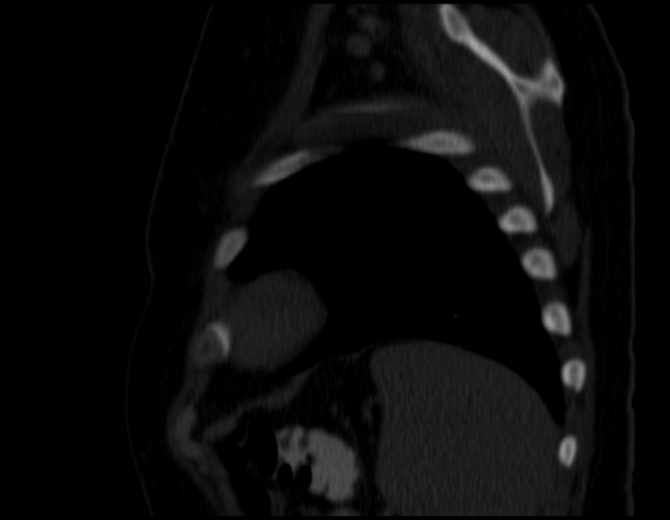Brown tumors compressing the spinal cord (Radiopaedia 68442-77988 Sagittal bone window 48).jpg