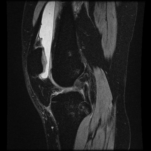 Bucket handle meniscus tear (Radiopaedia 56916-63751 H 47).jpg