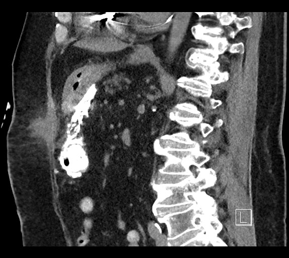 Buried bumper syndrome - gastrostomy tube (Radiopaedia 63843-72577 Sagittal Inject 52).jpg