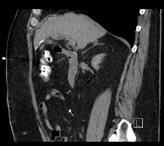 Buried bumper syndrome - gastrostomy tube (Radiopaedia 63843-72577 Sagittal Inject 78).jpg