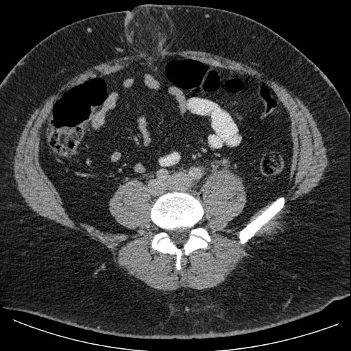 File:Burned-out testicular seminoma - retroperitoneal nodal metastases (Radiopaedia 62872-71245 A 48).jpg
