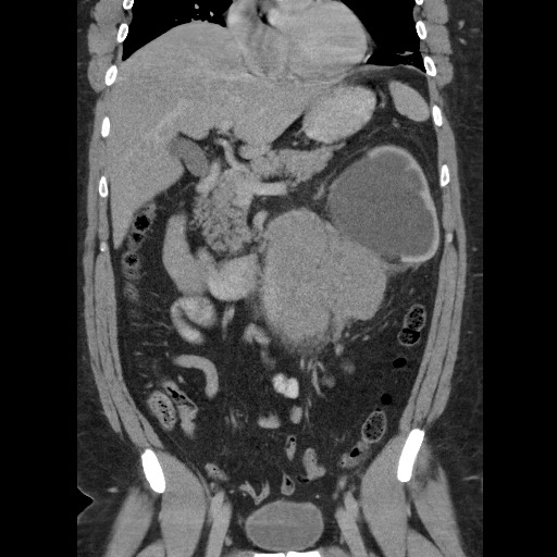 Burned-out testicular seminoma - retroperitoneal nodal metastases (Radiopaedia 62872-71245 B 30).jpg