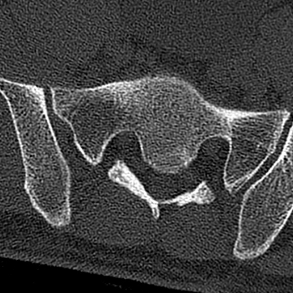 Burst fracture (Radiopaedia 53373-59357 Axial bone window 73).jpg
