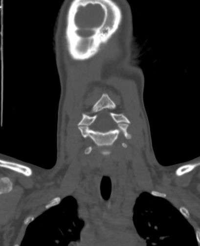 Butterfly vertebra (Radiopaedia 77903-90209 Coronal bone window 9).jpg